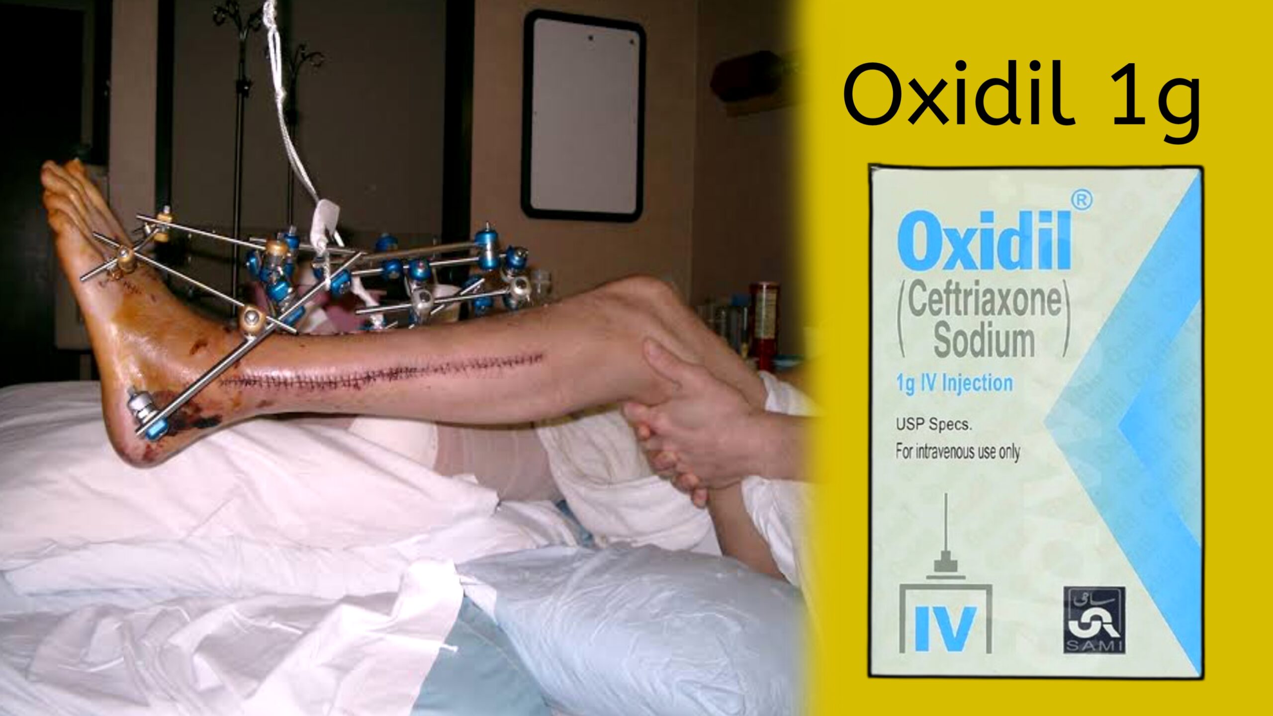 Oxidil 1g Injection